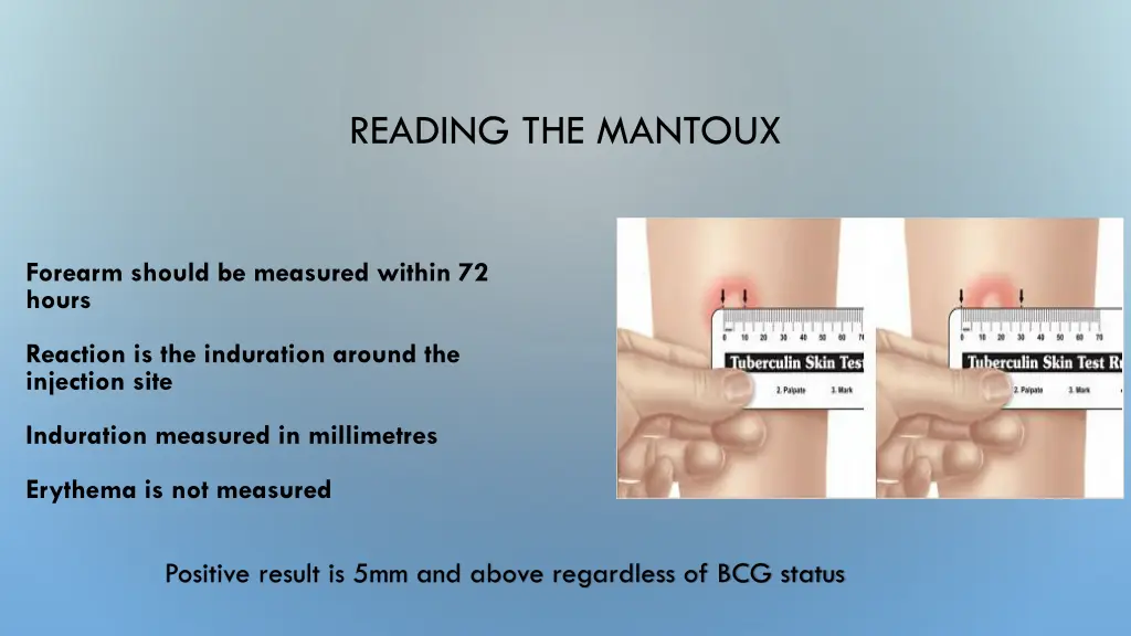 reading the mantoux