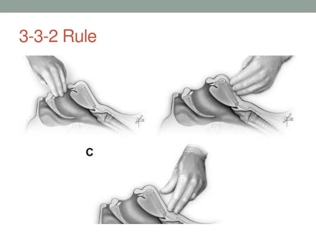 3 3 2 rule