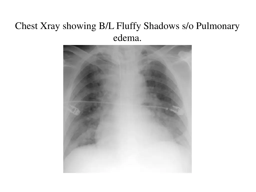 chest xray showing b l fluffy shadows