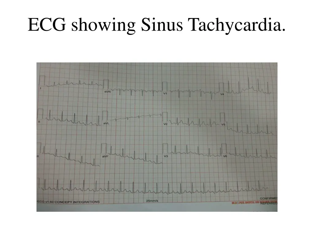 ecg showing sinus tachycardia