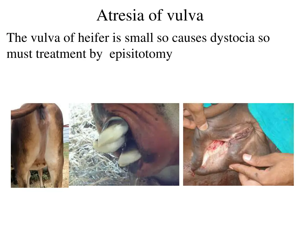 atresia of vulva