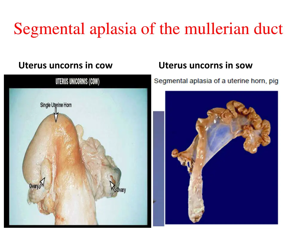 segmental aplasia of the mullerian duct 1