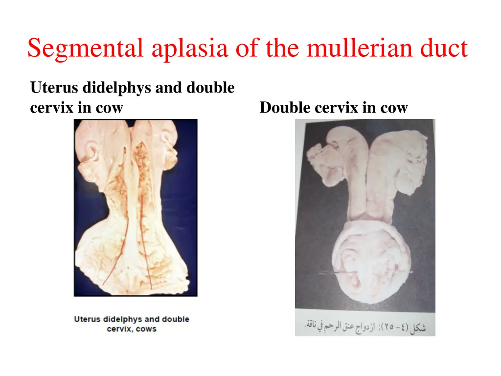 segmental aplasia of the mullerian duct