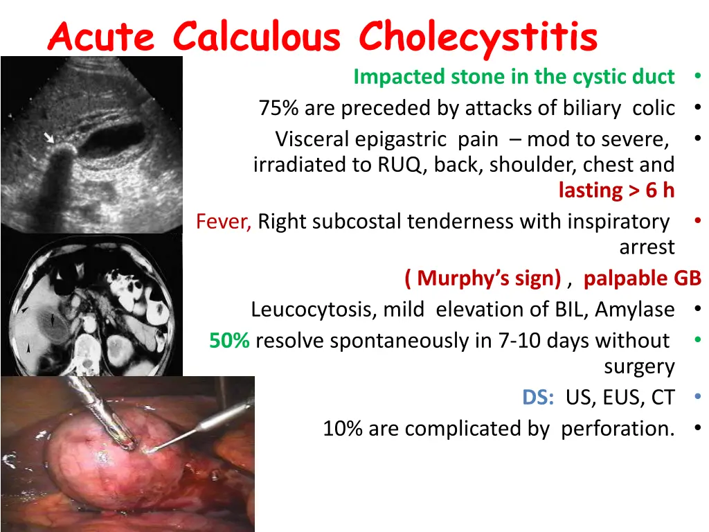 acute calculous cholecystitis