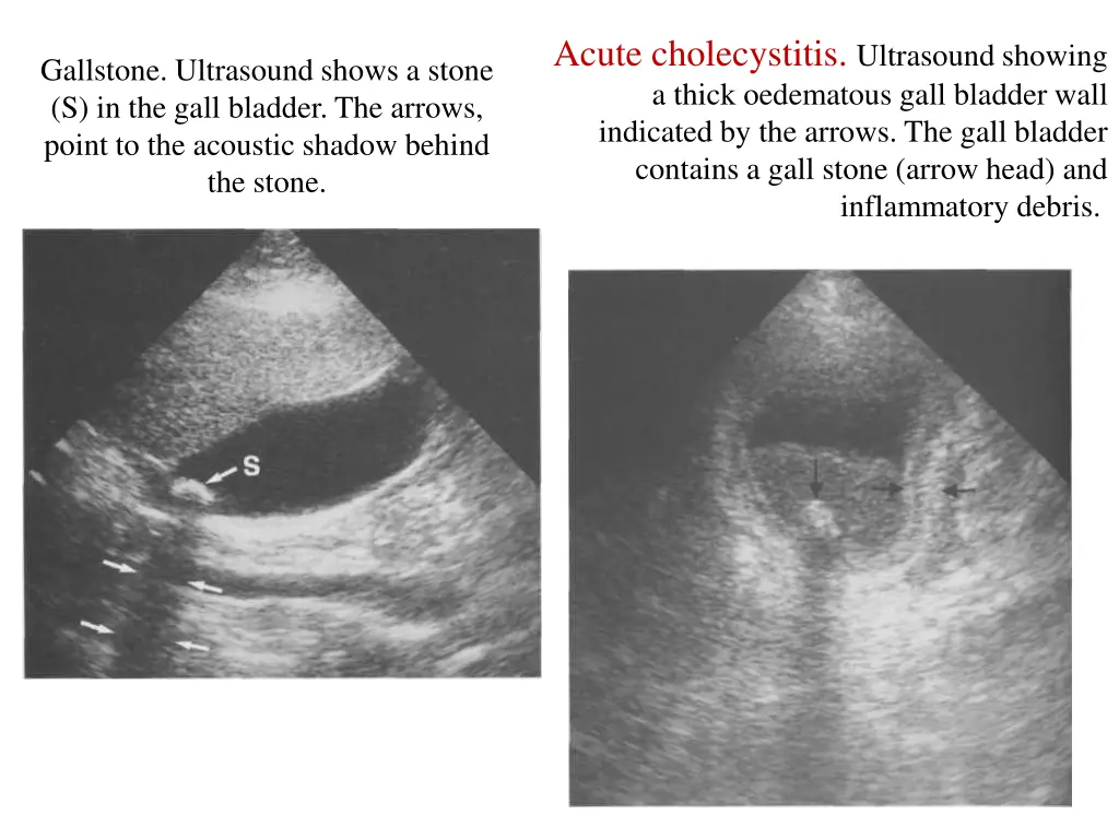 acute cholecystitis ultrasound showing a thick