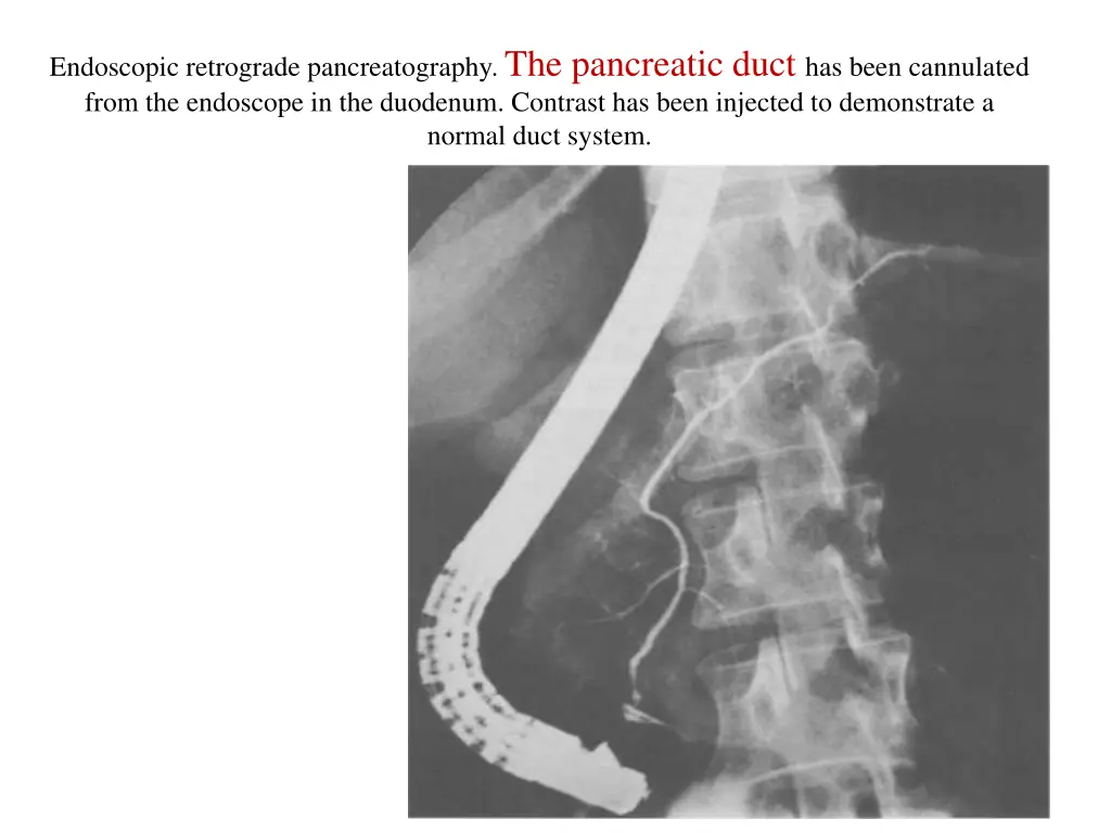 endoscopic retrograde pancreatography