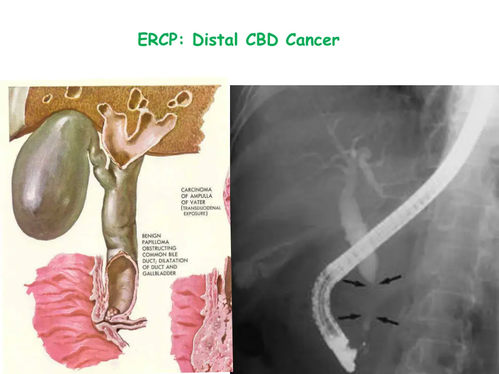 ercp distal cbd cancer