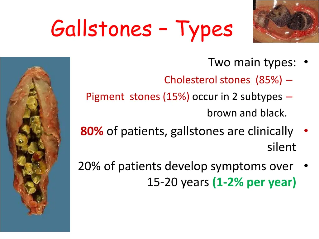 gallstones types