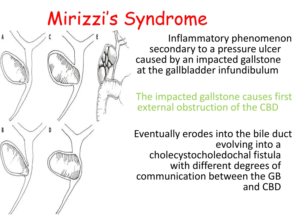 mirizzi s syndrome