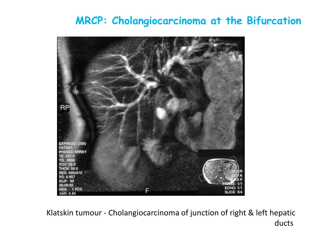 mrcp cholangiocarcinoma at the bifurcation