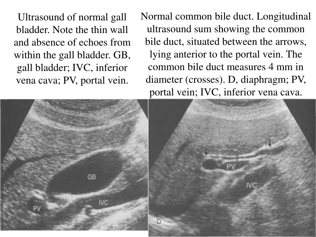 normal common bile duct longitudinal ultrasound