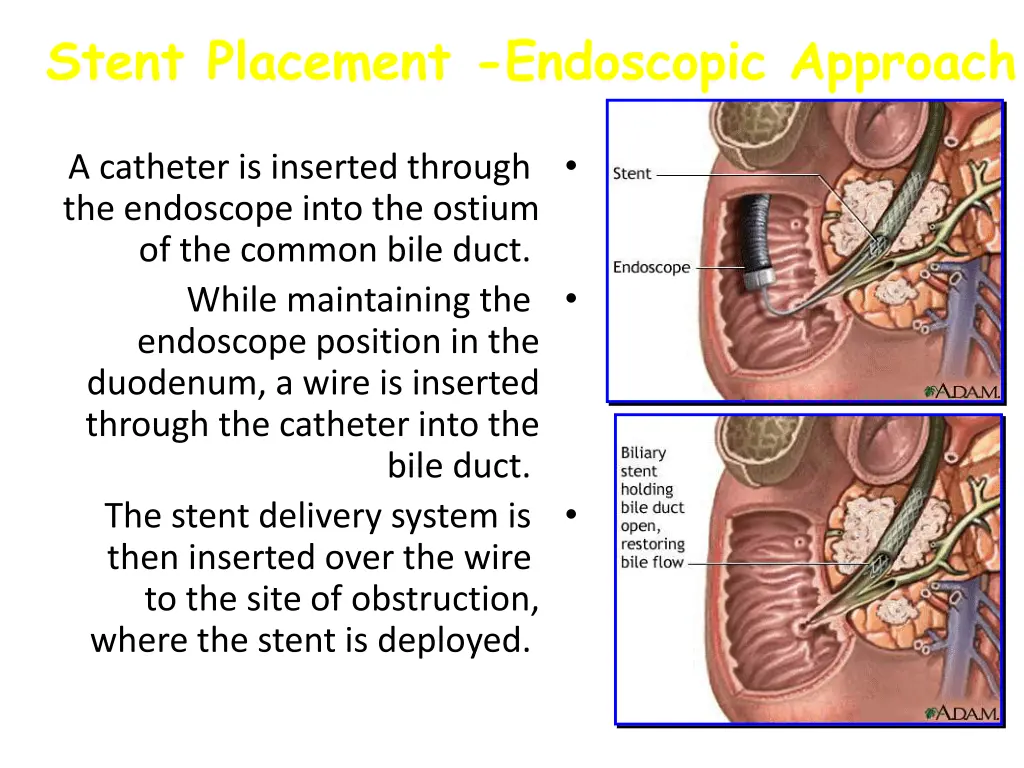 stent placement endoscopic approach