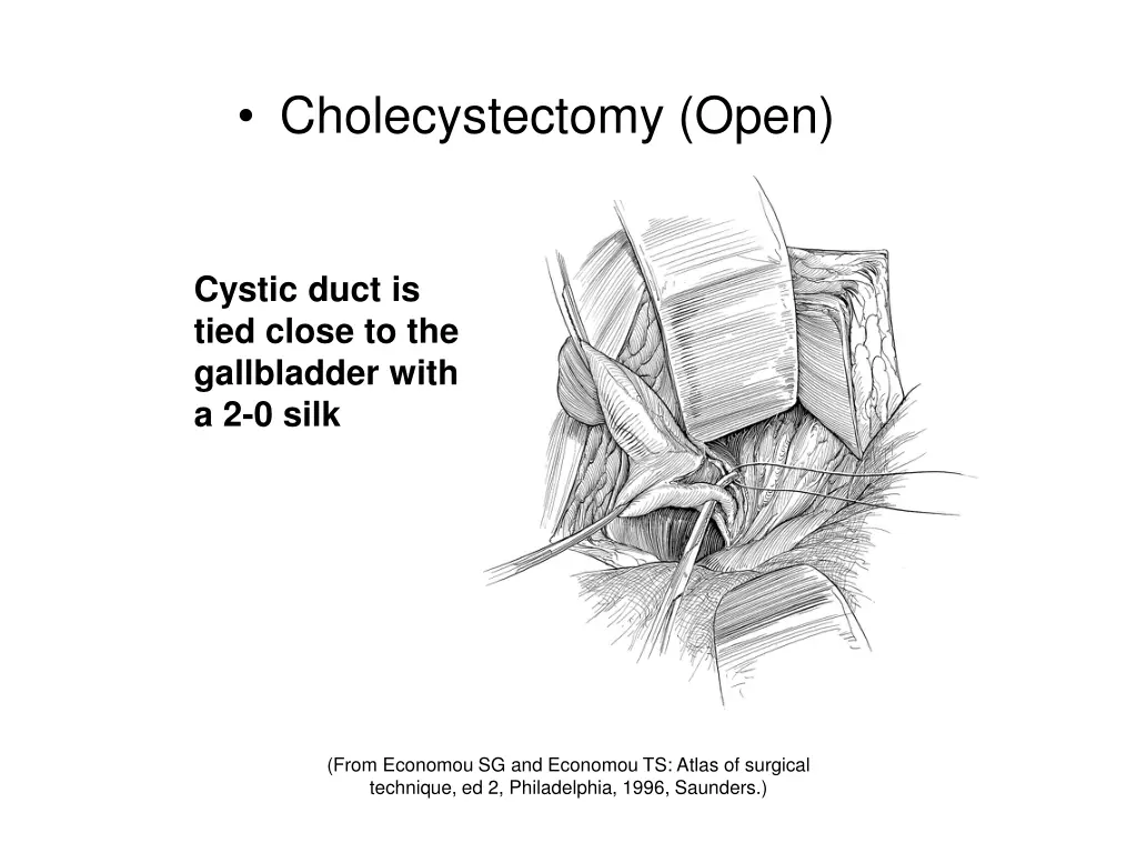 cholecystectomy open