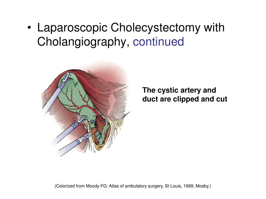 laparoscopic cholecystectomy with cholangiography 1