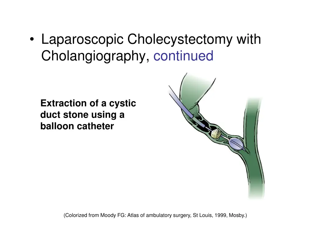 laparoscopic cholecystectomy with cholangiography 2