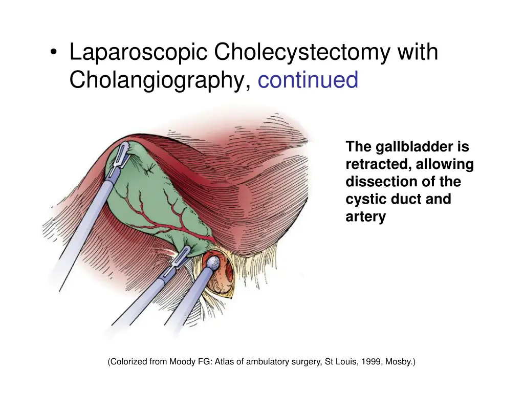 laparoscopic cholecystectomy with cholangiography