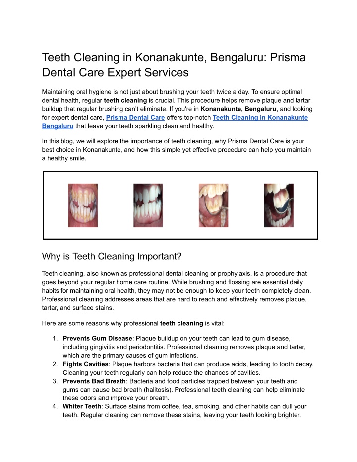 teeth cleaning in konanakunte bengaluru prisma