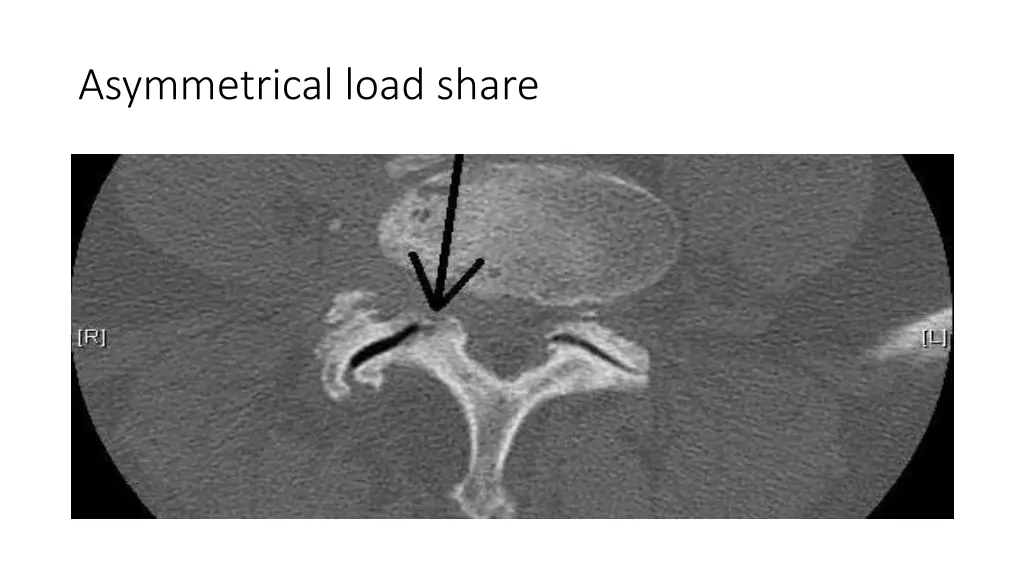 asymmetrical load share