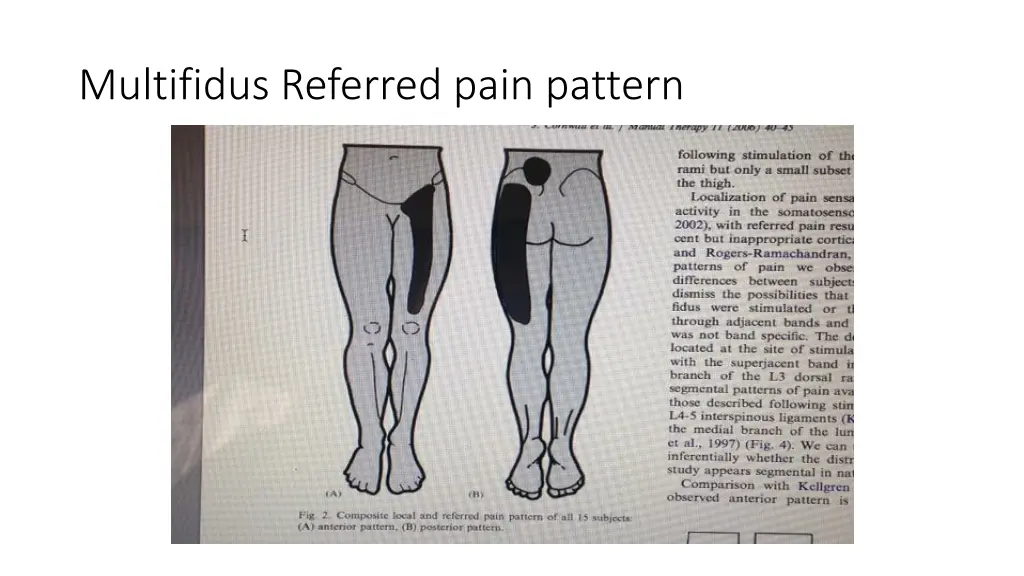 multifidus referred pain pattern