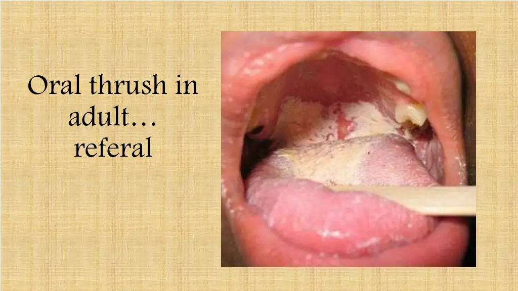 oral thrush in adult referal