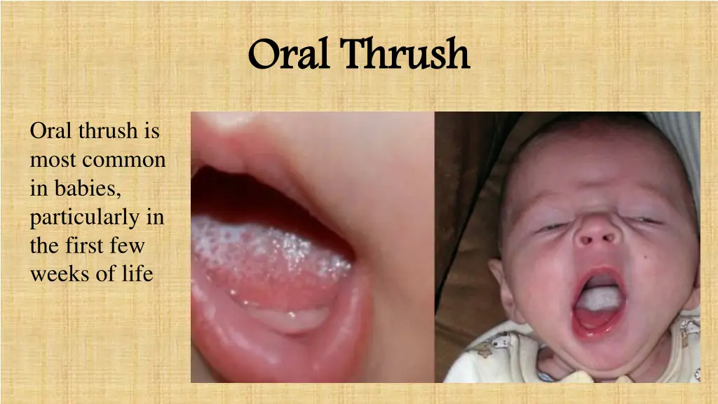 oral thrush