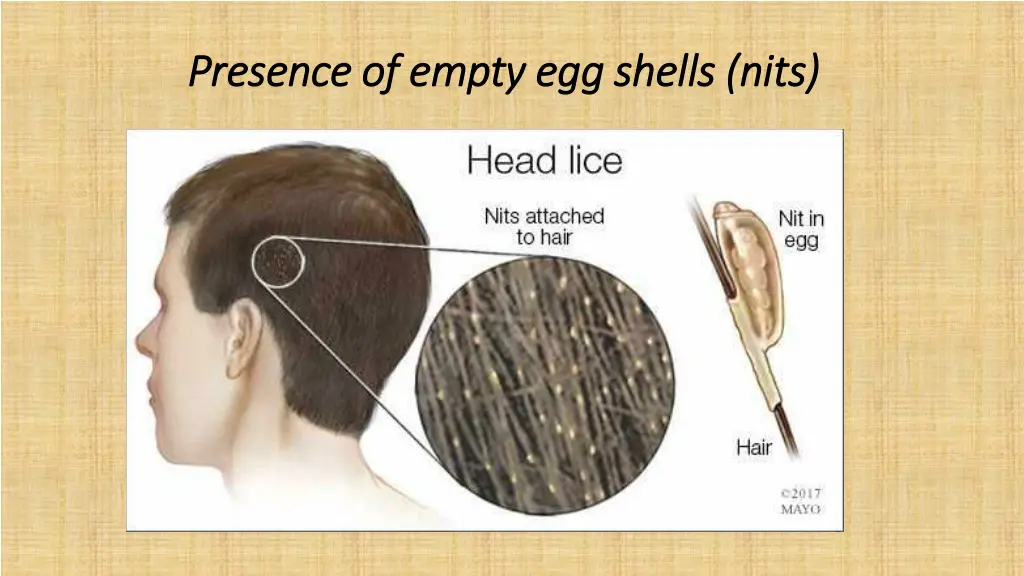 presence of empty egg shells nits presence