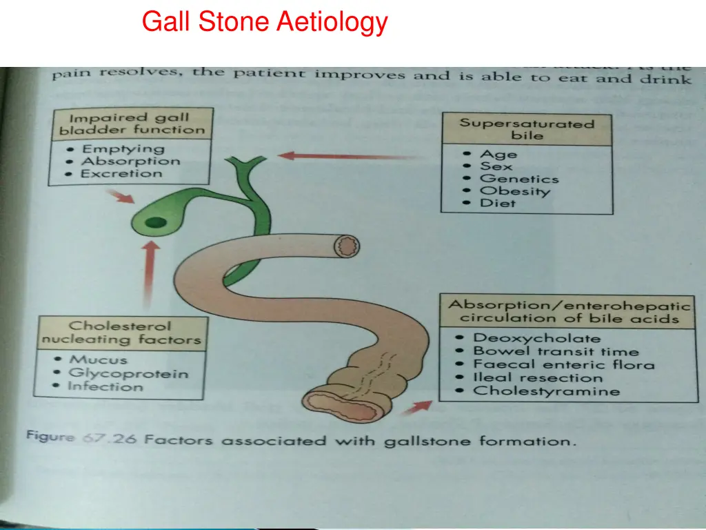 gall stone aetiology