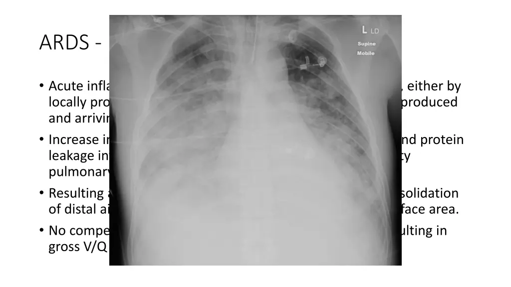 ards pathophysiology