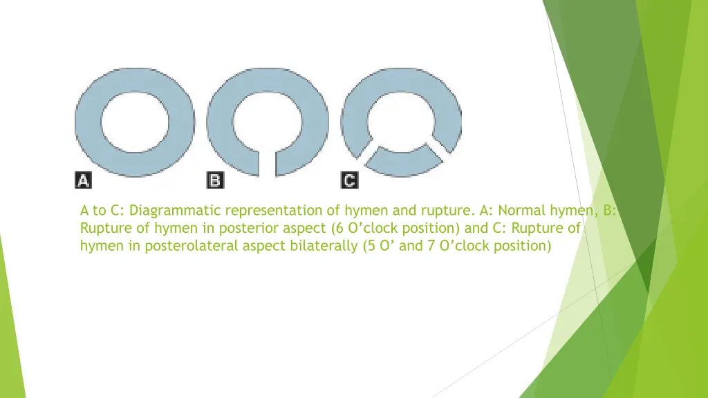 a to c diagrammatic representation of hymen