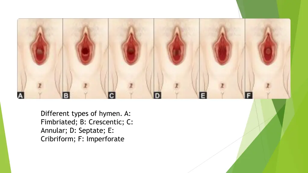 different types of hymen a fimbriated