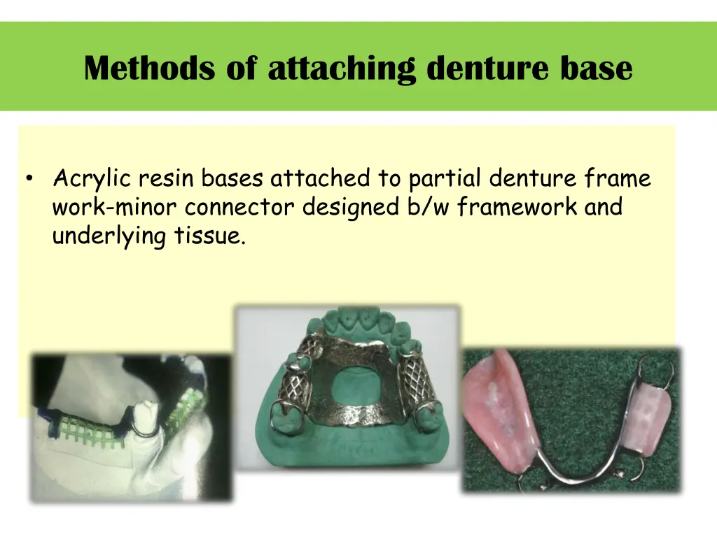 methods of attaching denture base