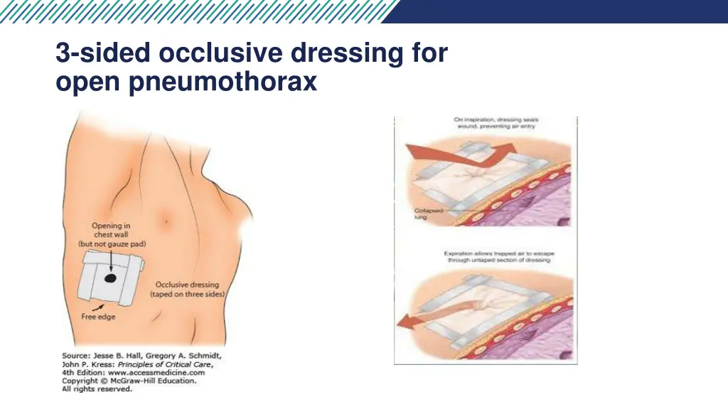 3 sided occlusive dressing for open pneumothorax