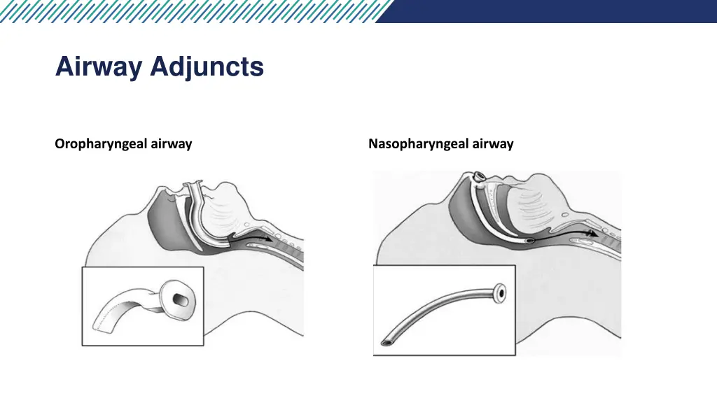 airway adjuncts