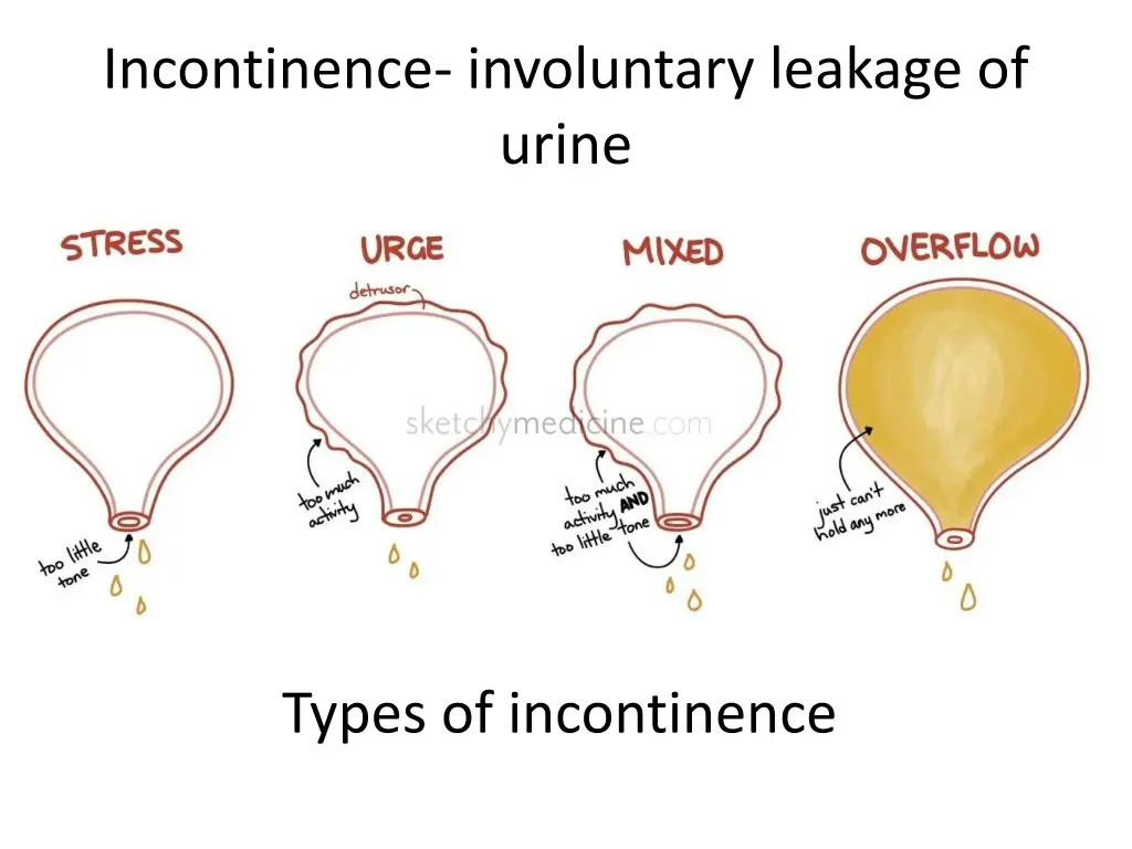 incontinence involuntary leakage of urine