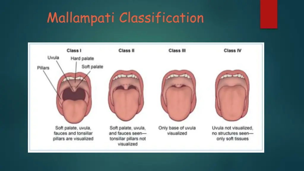 mallampati classification