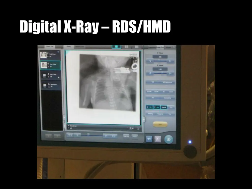 digital x ray rds hmd