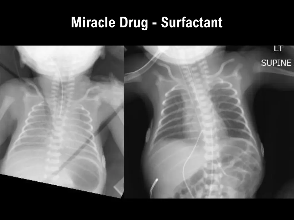 miracle drug surfactant