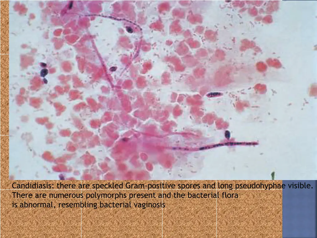 candidiasis there are speckled gram positive
