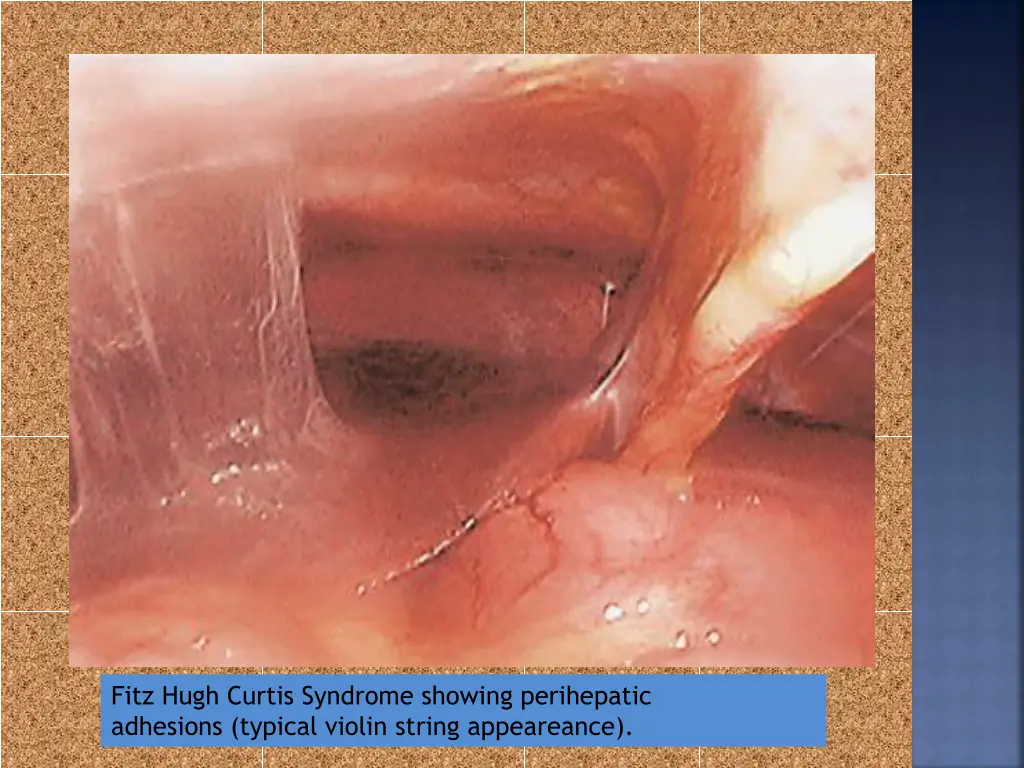 fitz hugh curtis syndrome showing perihepatic
