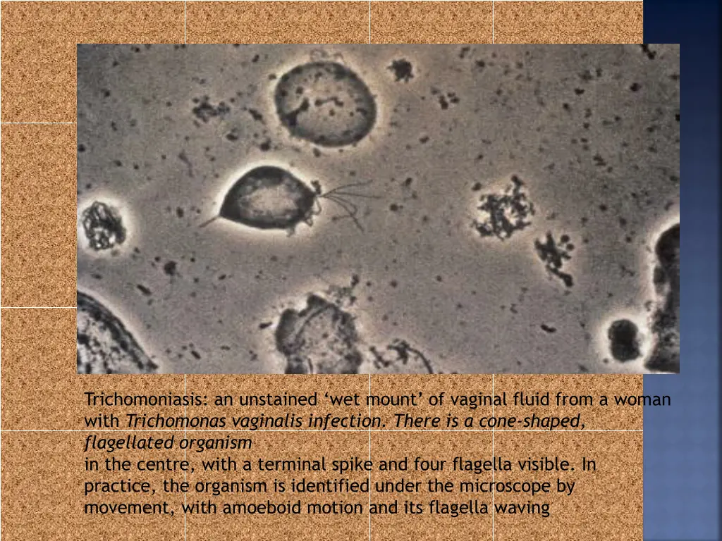 trichomoniasis an unstained wet mount of vaginal