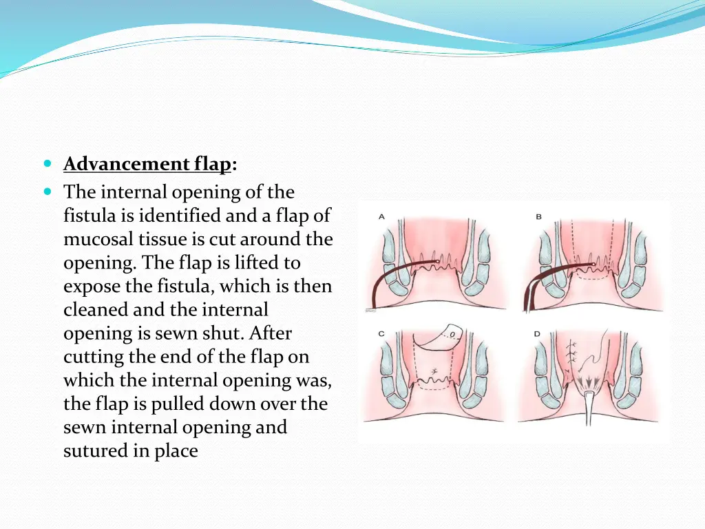 advancement flap the internal opening