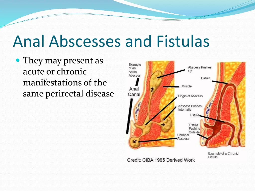 anal abscesses and fistulas