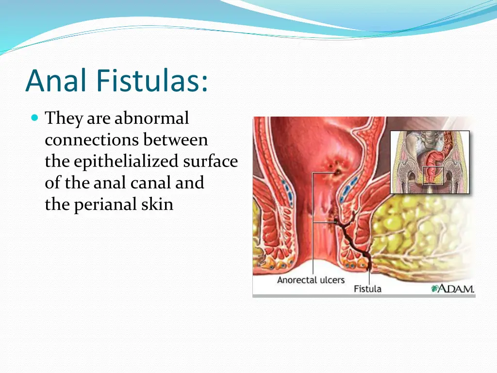 anal fistulas