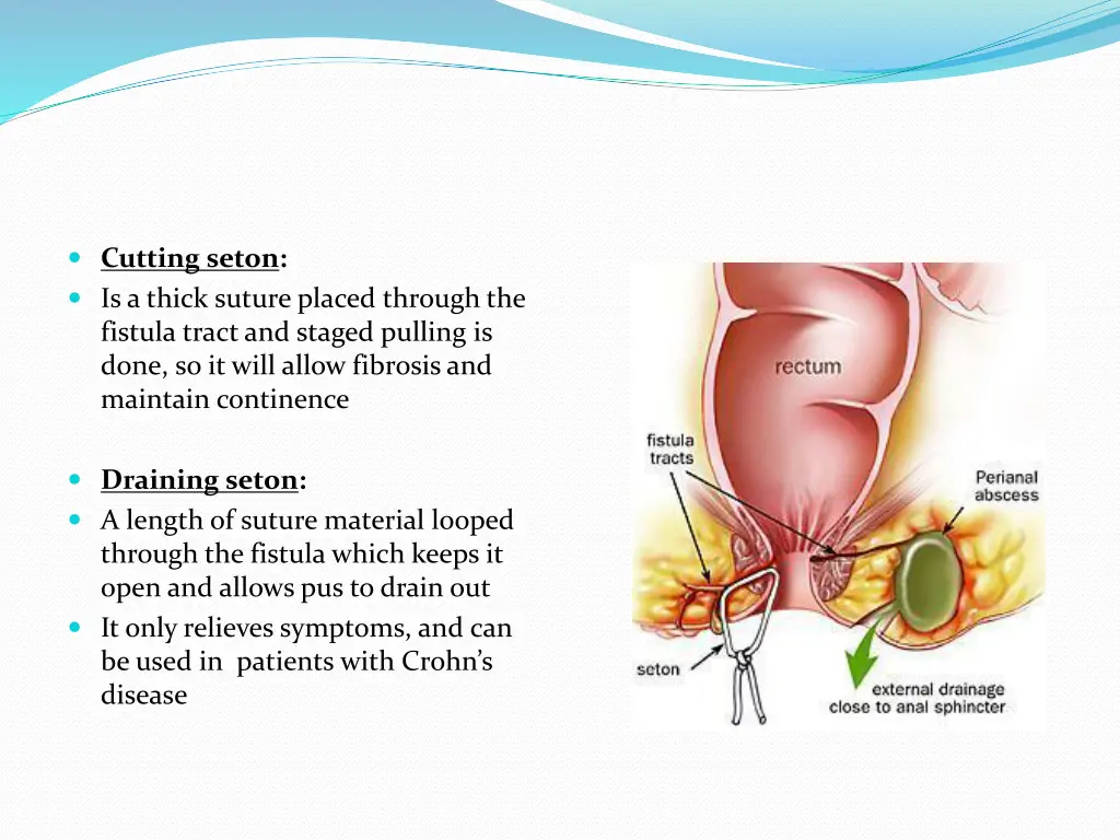 cutting seton is a thick suture placed through