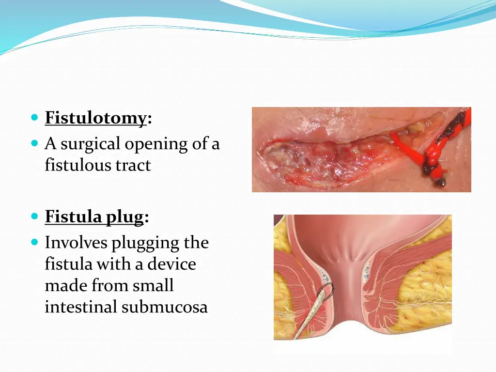 fistulotomy a surgical opening of a fistulous