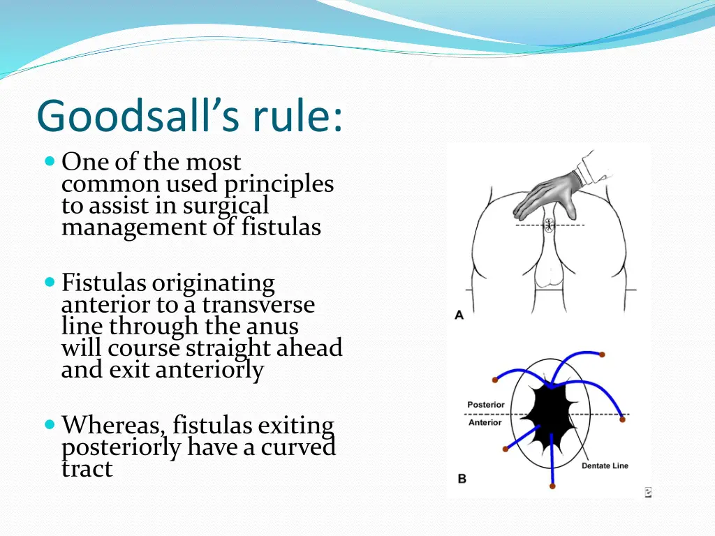 goodsall s rule one of the most common used