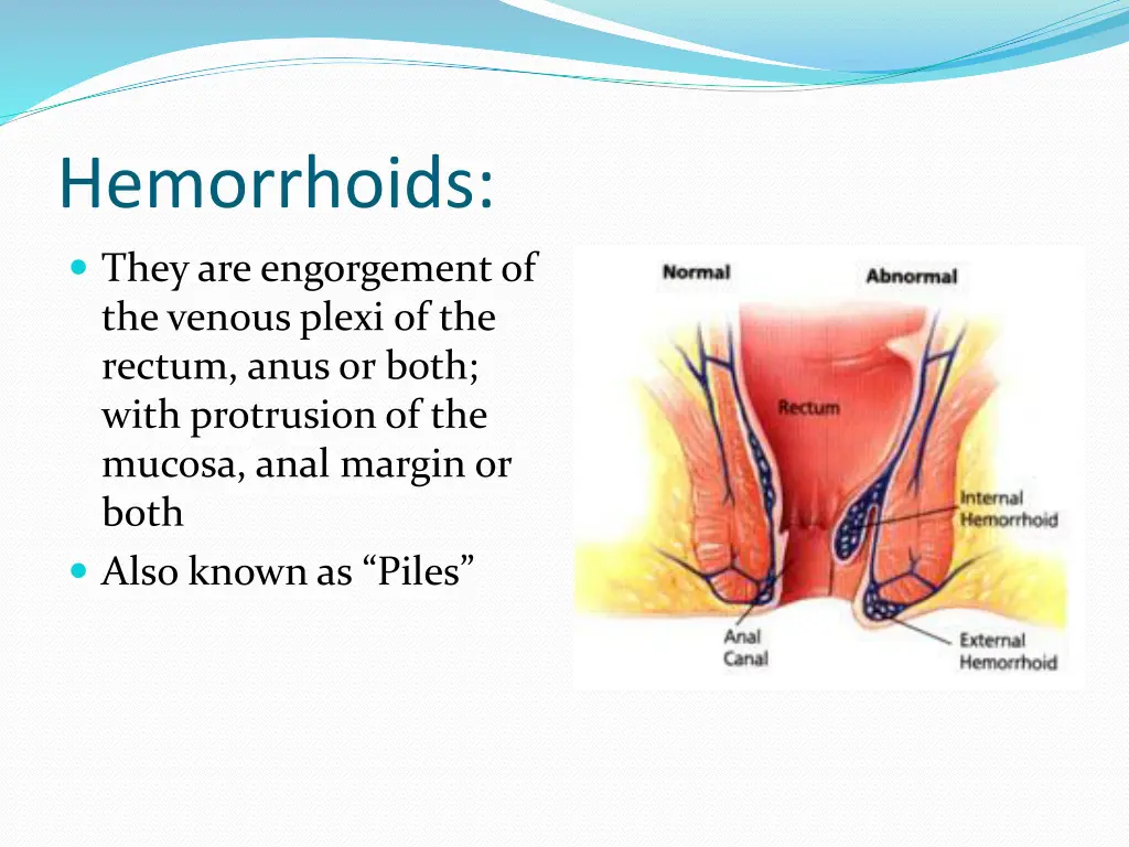 hemorrhoids