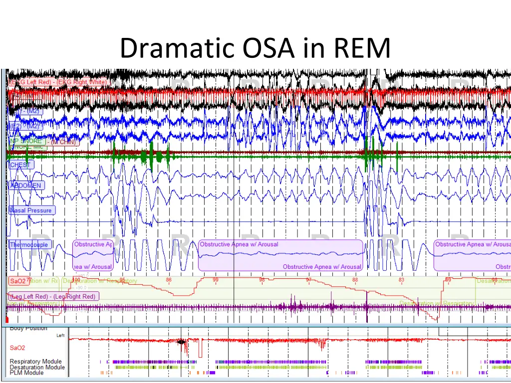 dramatic osa in rem