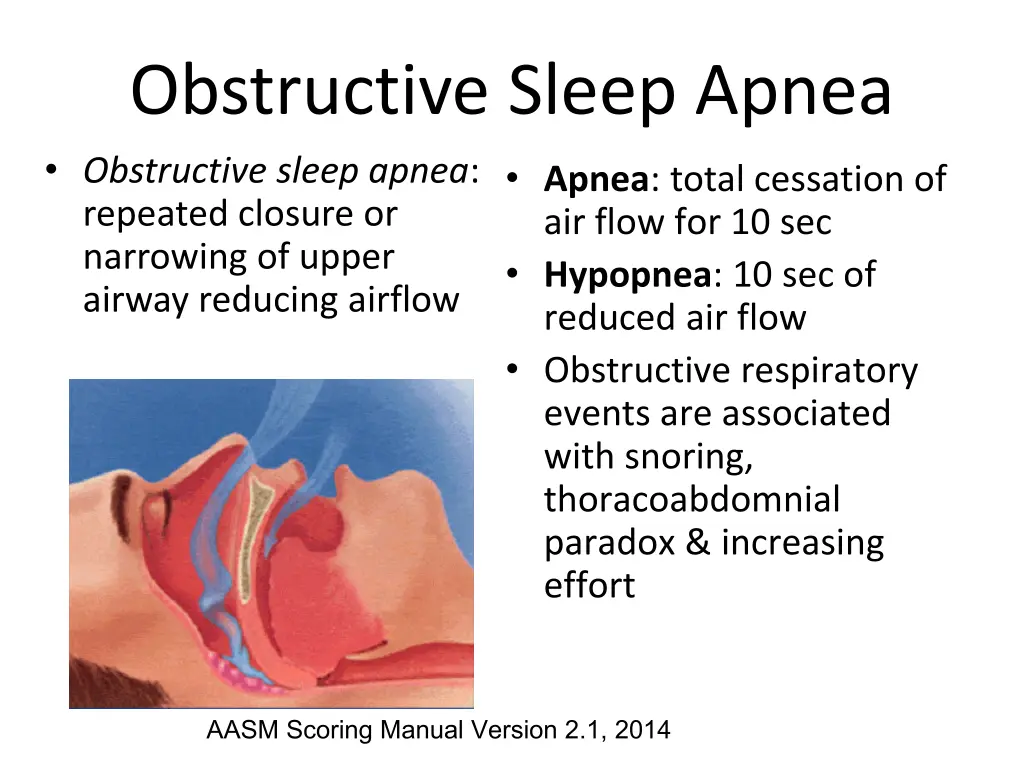 obstructive sleep apnea obstructive sleep apnea