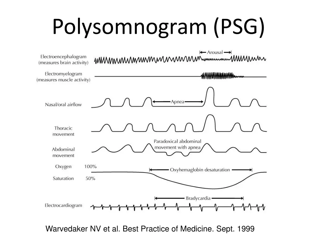 polysomnogram psg